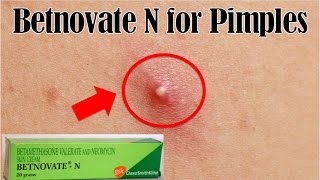 How to use Betnovate N for pimples  Remove pimples overnight remedy [upl. by Lapides472]