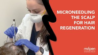 MicroNeedling the Scalp for Hair Regeneration [upl. by Noellyn389]