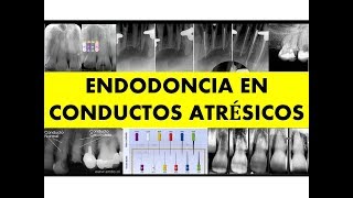 quotENDODONCIA EN CONDUCTOS ATRÉSICOSquot [upl. by Taylor]