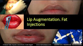 Lip Augmentation Fat Injections [upl. by Fennessy]