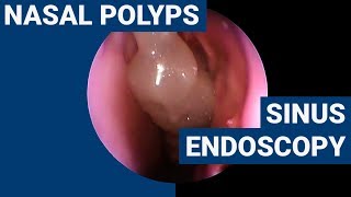 Nasal polyps  PHACON Sinus Patient Meyer [upl. by Kellene]