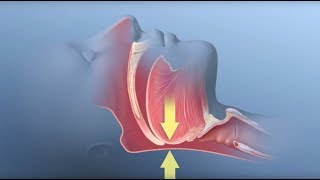 Correcting pediatric sleep apnea  Medical Minute [upl. by Smada]