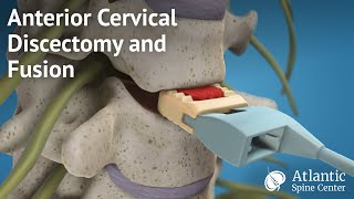 Days 13 recovery L4 L5 laminectomy discectomy [upl. by Correy]