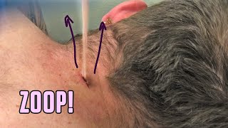 Leos Neck Abscess Packed and Re Packed [upl. by Dera]