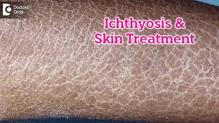 What is Ichthyosis How to Treat my Skin Fish like scales On SkinDrRasya Dixit  Doctors Circle [upl. by Amor370]